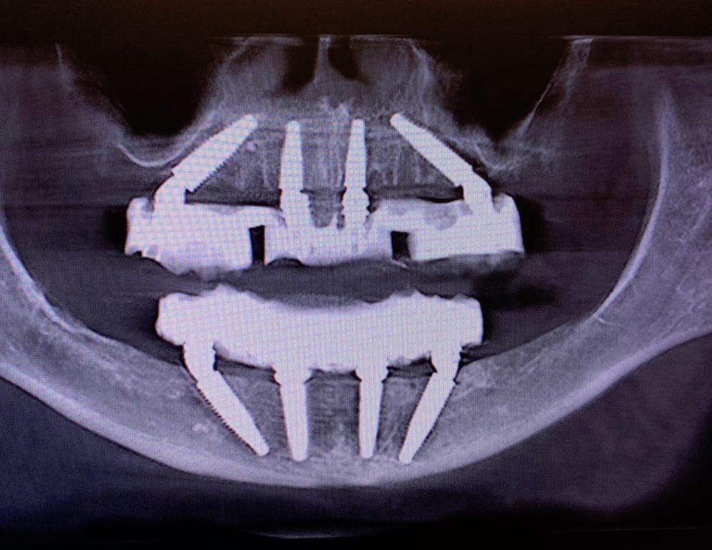 x-ray picture of dental implants Fort Worth, performed by Dr. Damon.