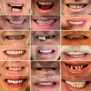 Dentures